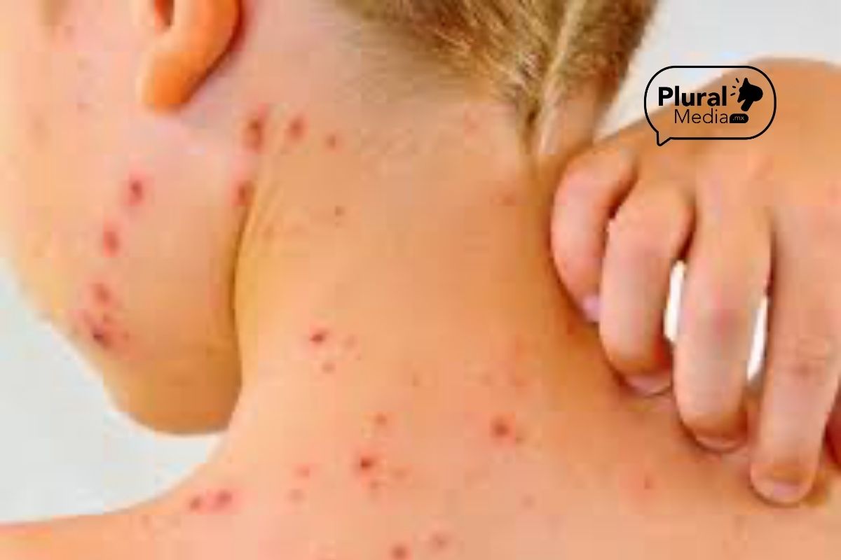 Suben a 83 los contagios de sarampión en Puebla- Salud